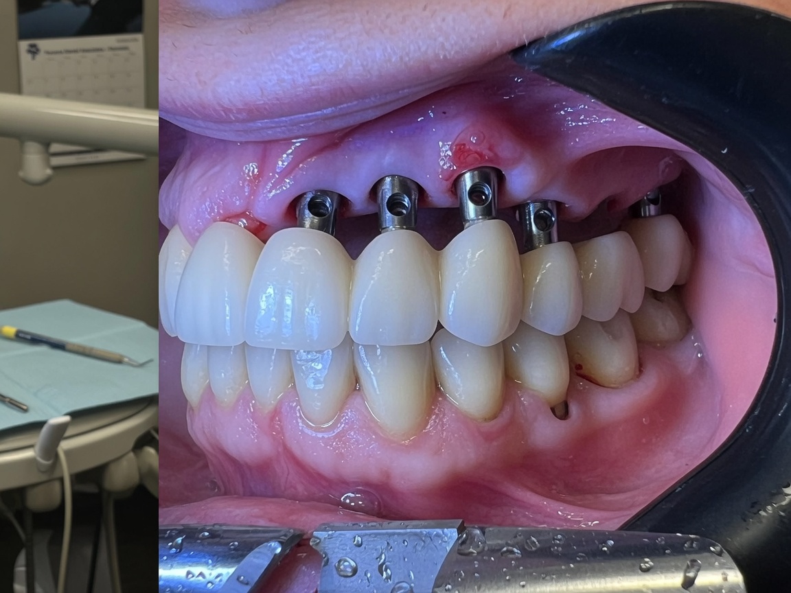 Implant Supported Bridges in Florence